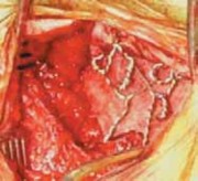 Illustration 16 for Cervical Fusion: The Line is Drawn for Lasting Stability