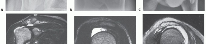 Illustration 2 for Subscapularis & Teres Rotator Cuff Repair: Advanced Techniques