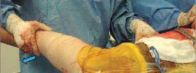 صورة طبية: إتقان توازن الأنسجة الرخوة لمفصل ورك صناعي مثالي: دليل شامل للمرضى مع الأستاذ الدكتور محمد هطيف