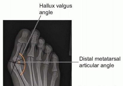 Is Surgical Correction of Juvenile Bunion Right for Your Child?
