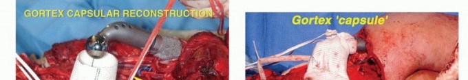 Illustration 11 for Mastering Total Scapular Resections: Reconstruction & Outcomes