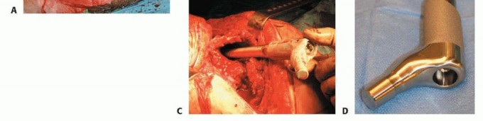 Illustration 14 for Hip Reimplantation Surgery: The Solution for Infected Implants