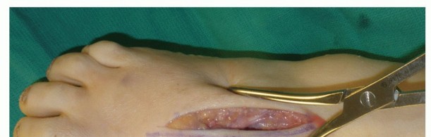 Illustration 47 for Mastering Midfoot Arthrodesis: Protect the Deep Neurovascular Bundle