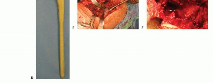 Illustration 8 for Hip Reimplantation Surgery: The Solution for Infected Implants