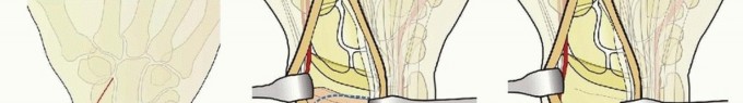 Illustration 19 for Fragment-Specific Fixation: Restore Carpal Facet Horizon