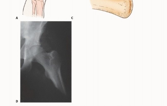 Illustration 16 for Mastering Above-Knee Amputation: Essential Surgical Insights