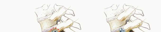 Illustration 9 for Anterior Thoracic Corpectomy: Decompression, Stabilization, Fusion