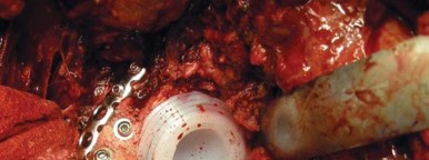 Illustration 52 for Navigating Early THA for Fractures of the Acetabulum