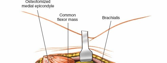 Illustration 37 for Mastering Elbow Approaches: Applied Surgical Anatomy for Precision