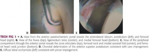 Illustration 111 for Mastering the Scope for Femoroacetabular Impingement