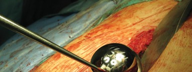 Illustration 65 for Figure Hip Resurfacing: Who Benefits and Who Should Avoid It?