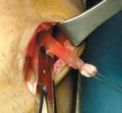 Illustration 13 for Optimizing Single-Bundle Anterior Cruciate Ligament Repair