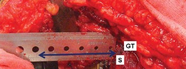صورة طبية: إتقان توازن الأنسجة الرخوة لمفصل ورك صناعي مثالي: دليل شامل للمرضى مع الأستاذ الدكتور محمد هطيف
