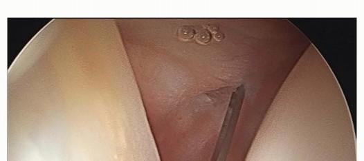 Illustration 20 for Hip Arthroscopy: Your Minimally Invasive Solution for Hip Pain