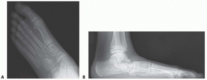 Illustration 5 for Calcaneal Lengthening Osteotomy: Correcting Hindfoot Valgus