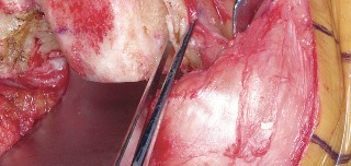 Illustration 50 for Mastering Valgus Total Knee Replacement: Techniques & Pitfalls