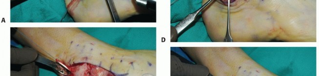 Secure Ankle Stability: Brostrom & Inferior Extensor Retinaculum Techniques