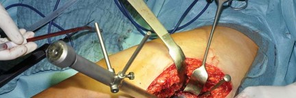 Illustration 21 for Collum Femoris Preserving: Achieve Better Primary Hip Outcomes