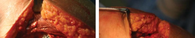 Illustration 15 for Considering METHA Short Stem? Discover Bone-Preserving THA