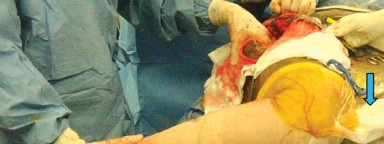 صورة طبية: إتقان توازن الأنسجة الرخوة لمفصل ورك صناعي مثالي: دليل شامل للمرضى مع الأستاذ الدكتور محمد هطيف