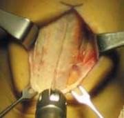 Illustration 10 for Optimizing Single-Bundle Anterior Cruciate Ligament Repair