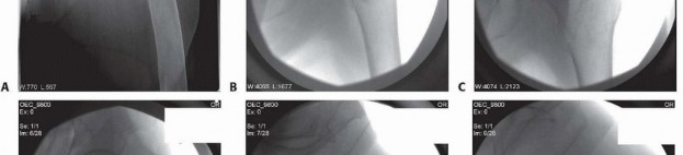 Illustration 11 for ORIF for Peritrochanteric Hip Fractures: Achieve Stable Mobility