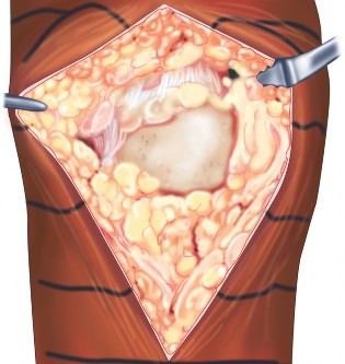 Illustration 3 for Monoblock Total Knee: When to Use & What to Avoid