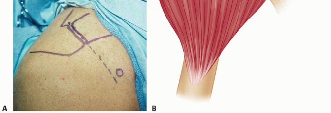 Illustration 10 for Subscapularis & Teres Rotator Cuff Repair: Advanced Techniques