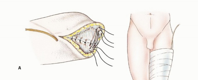 Illustration 18 for Below-Knee Amputation: Maximize Your Below-Knee Recovery & Function