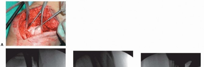 Illustration 47 for Repairing Distal Femur Fractures: Open Reduction & Internal Fixation