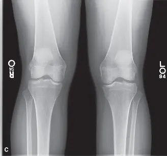 تمزق الرباط الصليبي الأمامي والغضروف الهلالي: دليلك الشامل للتشخيص والعلاج والتعافي في صنعاء