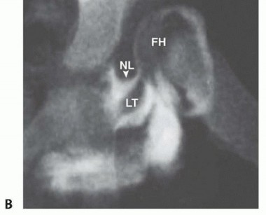 Illustration 4 for Mastering Anterior Open Reduction for Developmentally Dislocated Hip