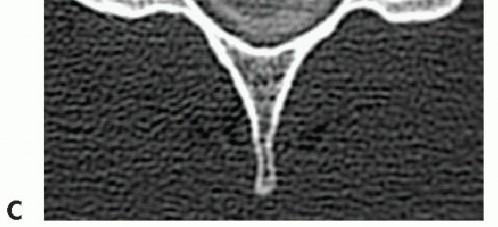 Illustration 9 for Stop Numbness & Instability: Corpectomy and Fusion Guide