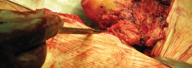 Illustration 59 for Figure Hip Resurfacing: Who Benefits and Who Should Avoid It?