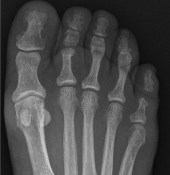 Illustration of rocker bottom modification - Dr. Mohammed Hutaif