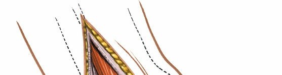 Illustration 91 for Optimized Approaches to the Dorsum of the Foot & Ankle
