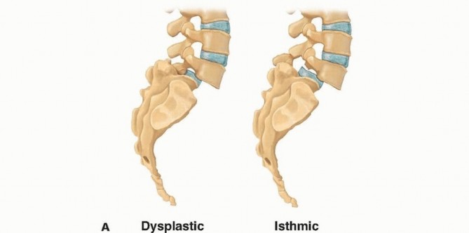 Illustration of posterolateral and interbody - Dr. Mohammed Hutaif