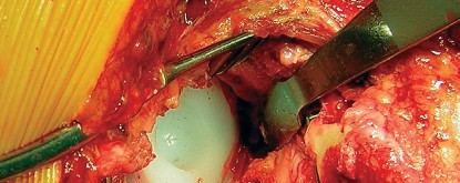 Illustration 66 for Cemented Component Longevity: The Critical Margin of the Acetabulum