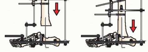 Illustration 22 for Beyond Amputation: Circular Fixation for Infection of the Talus