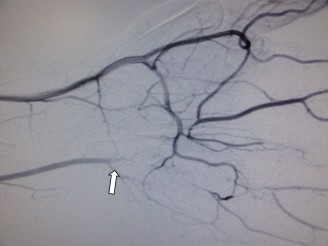 Illustration 9 for Christine M Kleinert Discussion: Solving Difficult Wrist Fractures