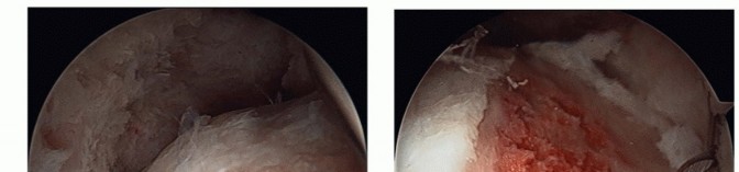 Illustration 32 for Hip Arthroscopy: Your Minimally Invasive Solution for Hip Pain