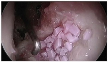 Illustration 7 for Hip Pain Relief: Arthroscopy for Nonstructural Pathology