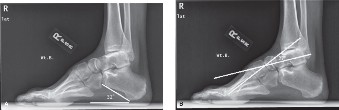 Illustration 4 for Pes Cavus & Ankle Pain: When to Use Coleman Block Testing