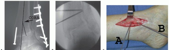 Illustration 3 for Unlock Ankle Preservation: Supramalleolar Closing Wedge Osteotomy