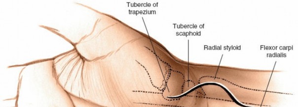 Illustration of scaphoid volar approach - Dr. Mohammed Hutaif