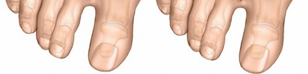 Illustration 213 for Optimized Approaches to the Dorsum of the Foot & Ankle