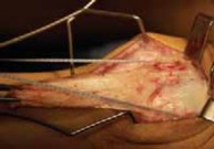 Unlock Better Movement: Femoral Osteotomy for Crouch Gait