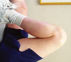 صورة طبية: تقويم مفصل الركبة أحادي الحجرة دليل شامل للمرضى في صنعاء