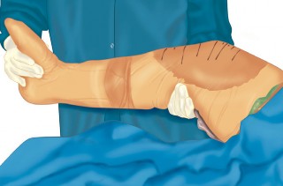 Illustration 10 for Mastering Gap Balancing in Revision TKA: Avoid Common Pitfalls