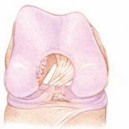 Illustration 27 for Optimizing Single-Bundle Anterior Cruciate Ligament Repair